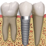 Dentista Dr Tiago Spanazzi Clareamento Dentistica